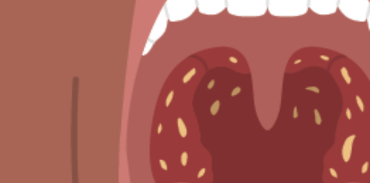 illustration of throat infection