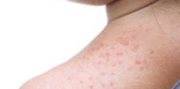 measles on shoulder
