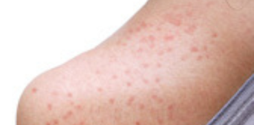 measles on shoulder
