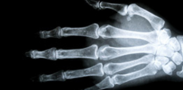xray of a hand